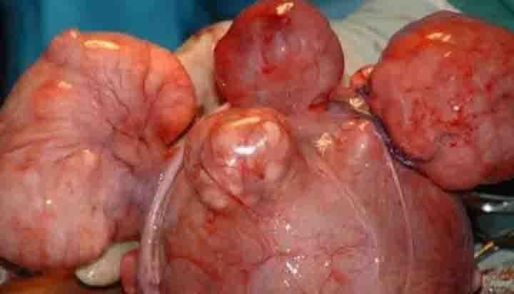 Le Fibrome utérin : quand faut-il recourir au traitement chirurgical ?(Pr Charlemagne Ouédraogo)