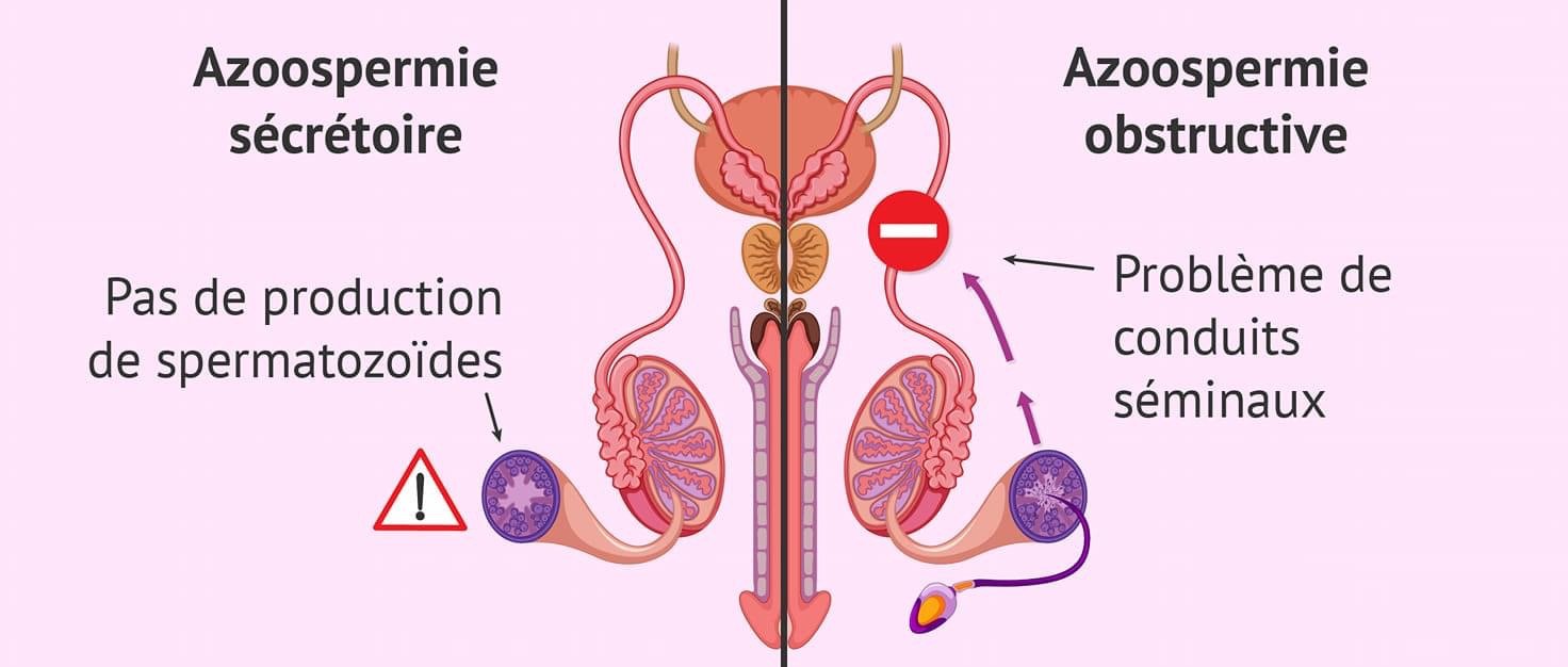 L&rsquo; Azoospermie, source de stérilité chez l&rsquo;homme : Pr Charlemagne Ouedraogo